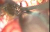 Brain Tumor - Cranio Pharyngioma - Microsurgery - Total Excision