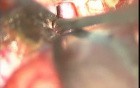 Brain Tumor - Cranio Pharyngioma - Microsurgery - Total Excision