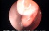 Clefted Concha Bullosa of Middle Turbinate