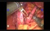 Robotic Hiatal Hernioplasty  