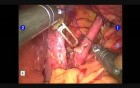 Robotic Hiatal Hernioplasty  