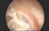 Middle Ear Atelectasis With The Erosion Of Incus And Stapes