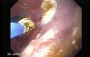 Endoscopic Ablation Of Barrett's Esophagus - 4/6
