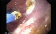 Endoscopic Ablation Of Barrett's Esophagus - 4/6