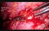 VTS Pleurectomy And Wedge Resection Of Left Upper Lobe