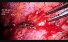 VTS Pleurectomy And Wedge Resection Of Left Upper Lobe
