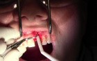 Pouch Technique, II - Extraction #9 with GBR-Socket Grafting