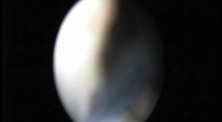 Retrograde Endopyelotomy - Part 2