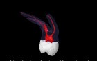 Maxillary Second Molar - Root Canal Anatomy