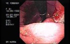 Ulcerative Gastric Adenocarcinoma of the Gastric Angle - Endoscopy