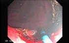 Endoscopic Resection of Giant Tubulo-Villous of the rectum (22 of 35)
