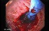 Esophagus - Pneumatic Dilation for Achalasia - Next Stages of This Procedure