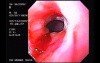 Slight Esophageal Stricture Due To Reflux Esophagitis