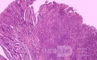 Adenocarcinoma of the Antrum and incisura angularis (10 of 12)