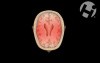 Closed Head Injury with Axonal Shearing