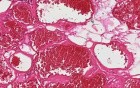 Lipohemangioma