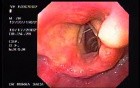 Oropharyngeal lipoma