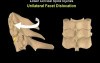 Spine Fractures - Cervical Spine Injury - Video Lecture