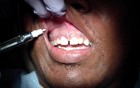 Almost Pain Free Anterior Maxilla Dental Anesthesia: Step 2