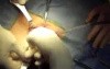 Inguinal hernia prosthetic repair