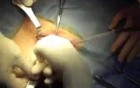 Inguinal hernia prosthetic repair