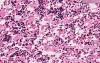 Bone Marrow - Erythroid Hyperplasia