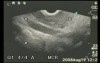 EUS-FNA in diagnosis of IPMT II