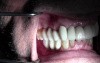 Final Restorations - Implant Reconstruction - #3-5, 7-10, 12-14, 28-30