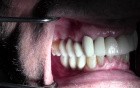 Final Restorations - Implant Reconstruction - #3-5, 7-10, 12-14, 28-30