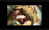 Palatoplasty