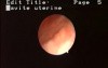Hysteroscopic Aspects Of Intrauterine Myomas