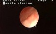 Hysteroscopic Aspects Of Intrauterine Myomas