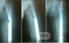 Osteoid Osteoma with impending fracture femur