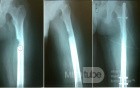 Osteoid Osteoma with impending fracture femur