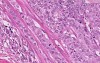 Transitional cell carcinoma
