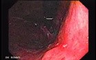 Giant Gastric Ulcer - Endoscopy (5 of 5)