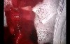 Dissection of Ruptured Aorta Type A - Surgical Repair