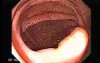 Adenocarcinoma of the Transverse Colon (5 of 5)