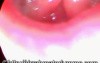 Hyperfunctional Voice