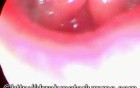 Hyperfunctional Voice