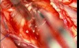 Cervical Spinal Cord Intramedullary Tumor - Microsurgical Excision