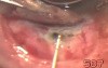 Leaking bleb excision