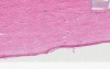 Skin, Kidney - Systemic Sclerosis (Scleroderma)