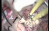 Hemispheric Cerebellar Astrocytoma - Suboccipital Approach