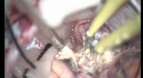 Hemispheric Cerebellar Astrocytoma - Suboccipital Approach