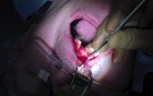 Bone Graft - Elevating Recipient Site Flap And Periosteal Release