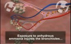 Anhydrous Ammonia Injuries