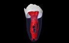 Mandibular Second Molar - 04 C-Shaped