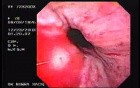Hemorrhage Due Status Post Rubber Band Ligation of Esophageal Varices - 