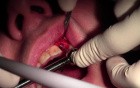 Narrow Platform Osseotite Implant Placement Into Mineross Regenerated Bone